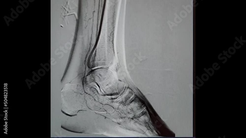 Left leg arteriogram with ankle joint photo