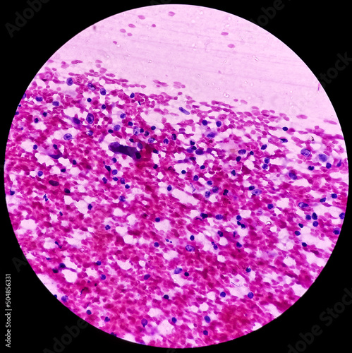 Chronic granulomatous inflammation with tuberculosis, vertebral and abdominal mass cytology, show epithelioid cells, lymphocytes, histiocytes. photo
