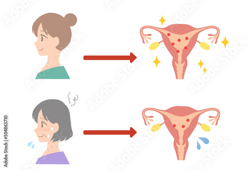 若い女性と中年女性の子宮　比較イラスト