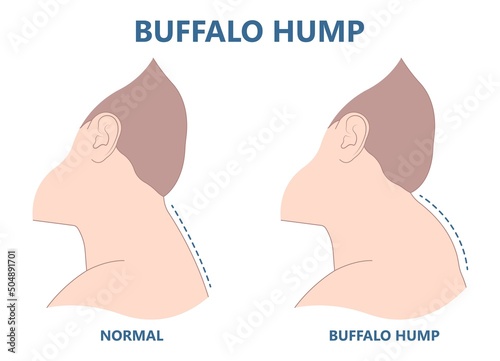 buffalo dowager's hump head bad poor women spine pad excess shape High level tumor cysts side effect body bone long term use curved muscle surgical diet Back sign photo