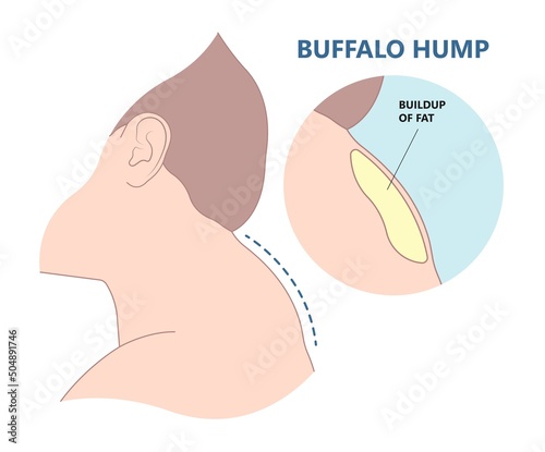 buffalo dowager's hump head bad poor women spine pad excess shape High level tumor cysts side effect body bone long term use curved muscle surgical diet Back sign photo
