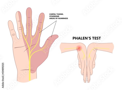 Foto Phalen test diagnose wrist flexion bend hand nerve compression pain treat ache a