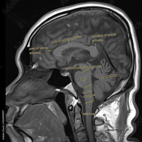 Mid sagital normal anatomy t1 weighted MRI  photo