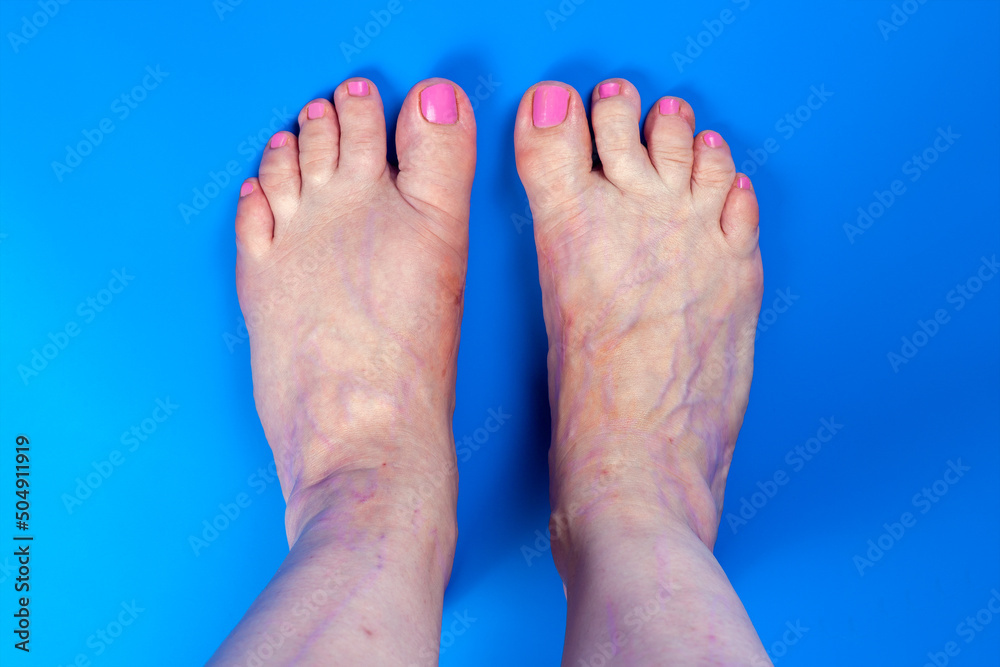 Human legs with scars from trauma, surgery and hypertrophied veins. Result of tight shoes, deformity great toe or first metatarsophalangeal joint, hallux valgus or bunion. Blue background, copy space. Human legs with scars from trauma, surgery and hypertrophied veins. Result of tight shoes, deformity great toe or first metatarsophalangeal joint, hallux valgus or bunion. Blue background, copy space.