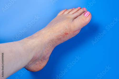 Closeup left human leg with scar from trauma or surgery and veins. Result of tight shoes, deformity great toe or first metatarsophalangeal joint, hallux valgus or bunion. Blue background, copy space.