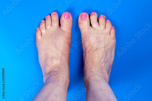 Human legs with scars from trauma, surgery and hypertrophied veins. Result of tight shoes, deformity great toe or first metatarsophalangeal joint, hallux valgus or bunion. Blue background, copy space.
