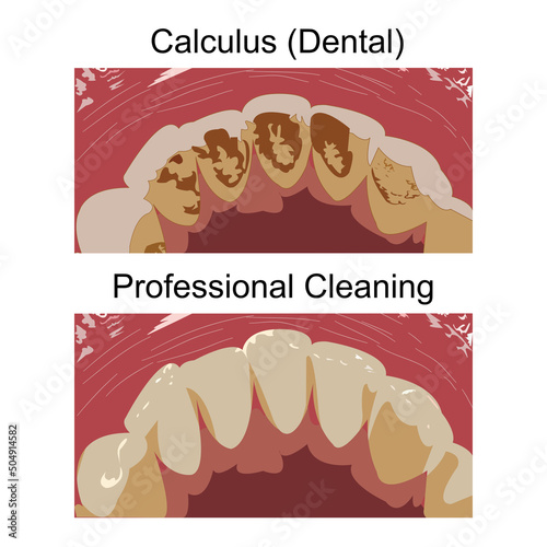 Vector flat design of heavy staining and calculus deposits exhibited on the lingual surface of the mandibular anterior teeth ,along the gum line are signs that needs professional cleaning from dentist
