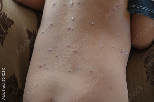 Young boy with varicella zoster virus. Closeup of skin with chickenpox bubble rash on child