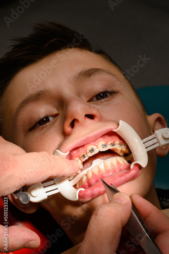 The teenager has braces glued to his upper teeth to straighten them  and the boy has a retractor on his lips.