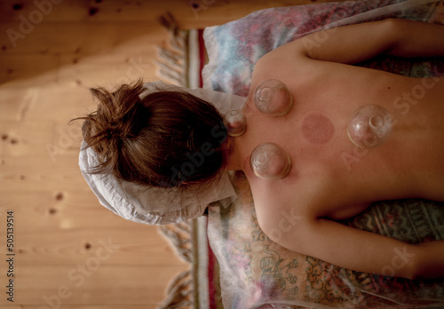 High angle view of relaxed young woman receiving cupping treatment on back, traditional chinese medicine. photo