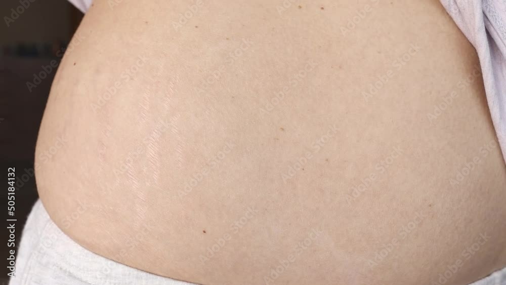 The woman lifts her clothes and shows the stretch marks on her stomach that appeared after childbirth. The woman lifts her clothes and shows the stretch marks on her stomach that appeared after childbirth.