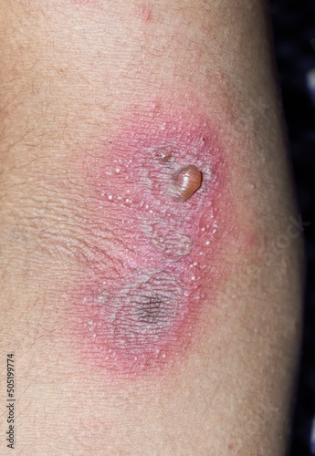 Paederus dermatitis in arm. It is a peculiar, irritant contact one caused by a beetle belonging to genus Paederus. photo