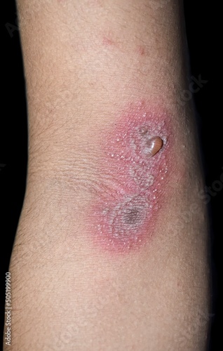 Paederus dermatitis in arm. It is a peculiar, irritant contact one caused by a beetle belonging to genus Paederus. photo