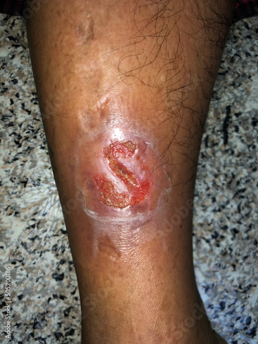 Bacterial wound infection. Infected traumatic wound in the leg.