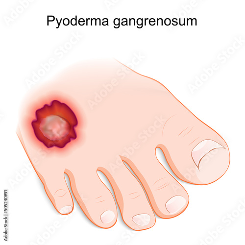 Pyoderma gangrenosum. inflammatory skin disease