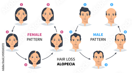 Hair loss stages, androgenetic alopecia male and female pattern. Steps of baldness vector circle infographic in a flat style with a man and a woman. Changing the hairline on the scalp