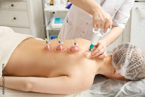 Vacuum massage. Vacuum cups of medical cupping therapy on woman back, close up, chinese medicine.