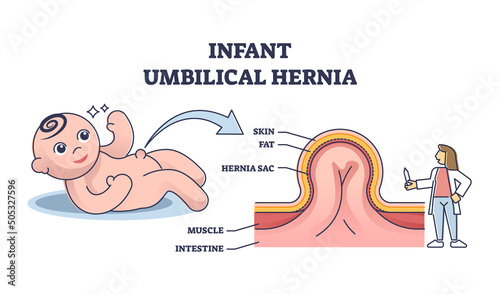 Infant umbilical hernia as painless lump near belly button outline diagram. Labeled educational scheme with newborn children stomach with skin, fat, sac, muscle and intestine vector illustration.