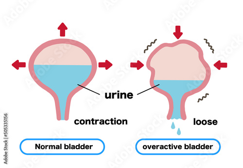 Leakage of urine Illustration of bladder mechanism
