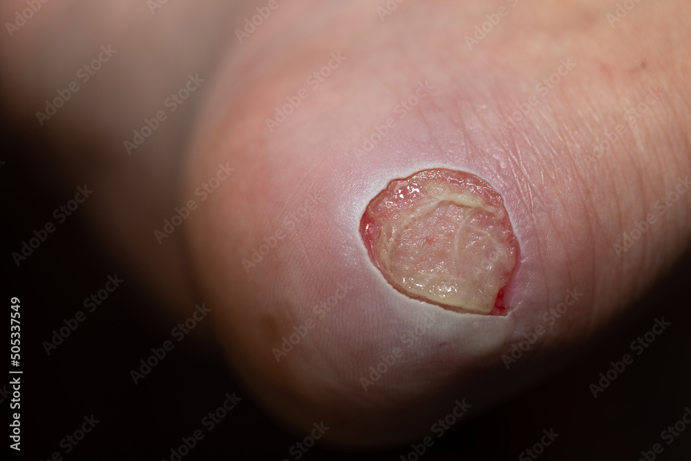 Ταπετσαρία Close Up foot bloody callus on man's heel.