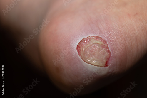 Close Up foot bloody callus on man's heel. photo