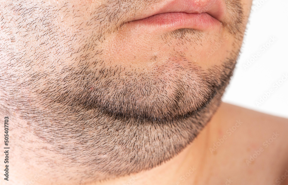 The face of an overweight man. Fat double chin. Aesthetic defect. double chin correction, close-up