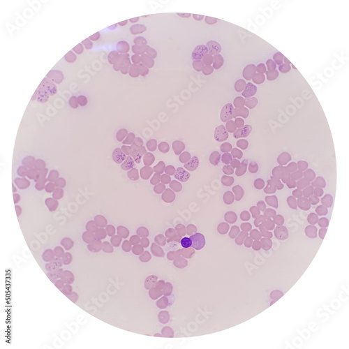Reticulocyte count under 100x light microscope by using New methylene blue stain and stained again with Wright-Giemsa stain. A reticulocyte stain measures aggregates of residual ribosomes. photo