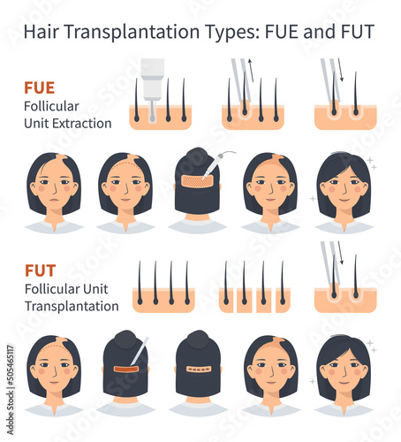 Female hair transplantation FUE and FUT, stages of Follicular Unit Extraction. Treatment of baldness, alopecia and hair loss. Vector medical infographic, woman's head scalp. Strip and graft machine.