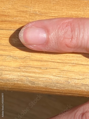 terrys nail is white with red band tip & missing half moon  can be diseases,  photo