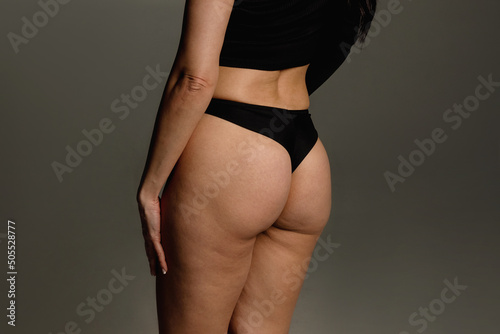 Buttocks and hips woman with cellulite and stretch marks close-up before liposuction procedure and cosmetic therapy photo