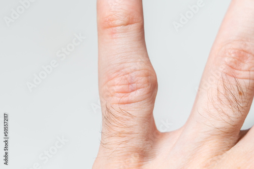 A protruding bone on the finger of the hand. Incorrect bone fusion. Recovery after a broken finger. Problems with genetics. Improper metabolism. Close up. photo