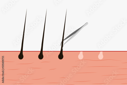 Pulling out body hair with a tweezer vector. Using a tweezer to pull out body hair from the skin. Skin vector illustration with hair and a tweezer. Hair removal concept from the skin.