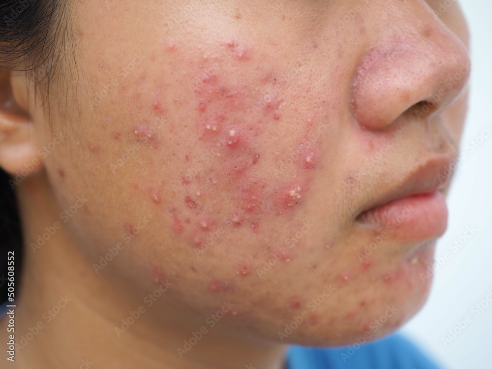 Teenage girl having problems of acne inflammation on her face. concept of facial care products. closeup photo, blurred. Teenage girl having problems of acne inflammation on her face. concept of facial care products. closeup photo, blurred.