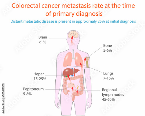 Vector illustration of colorectal cancer metastasis, medical diagram