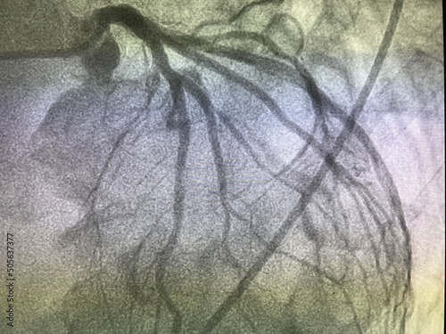 coronary artery angiography ,Coronary artery disease , left coronary angiography	
 photo