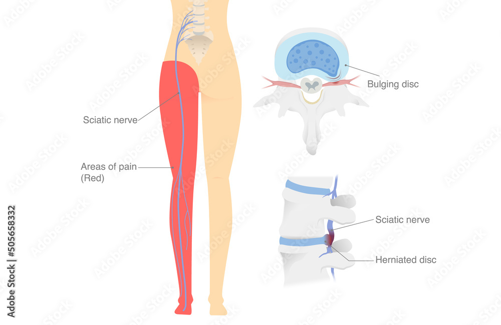 Vetor de Diagram shows the Sciatica nerve from a herniated disc and trapped  nerves make patients pain in the legs and hip areas. Illustration about  medical diagram. do Stock