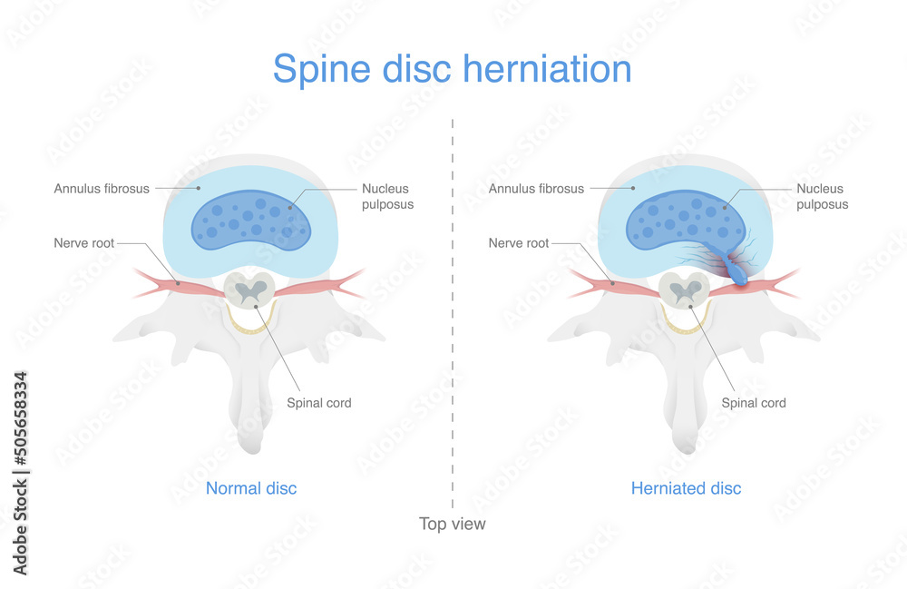 Comparing normal spine and disc herniated people is an injury to the