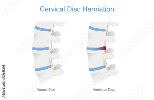 Comparing normal cervical disc and disc herniated of the patient. Illustration of Medical diagram about the problem on the spine makes pain or disability. photo