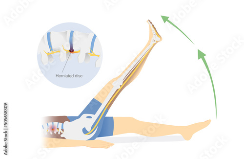 People doing sciatica stretches for pain relief from Herniated disc. Exercise diagram for back pain treatment with raising legs. Physical Therapy. photo