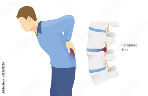 Man has low back pain and sciatica from a herniated disc. Medical diagrams about trapped nerves make patients chronic pain in the back and paralysis.