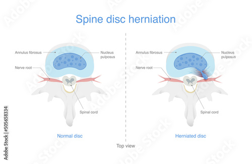 Comparing normal spine and disc herniated people is an injury to the cushioning and connective tissue between vertebrae. Illustration of Medical diagram. photo
