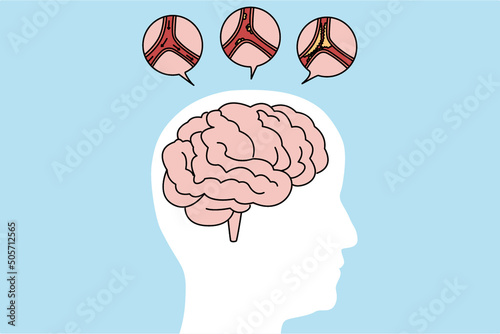 Medical illustration of human brain stroke 