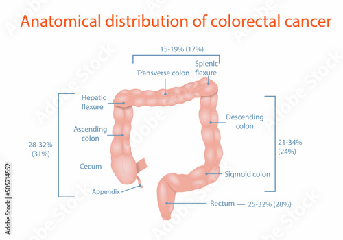 Anatomical distribution of colorectal cancer, medical diagram photo