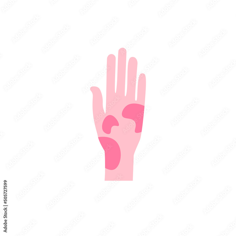 Contact dermatitis flat design long shadow color icon. Skin redness, rash, irritation. Phytophotodermatitis, poisonous plant allergy. Food, insect bite allergic symptom. Vector silhouette illustration Contact dermatitis flat design long shadow color icon. Skin redness, rash, irritation. Phytophotodermatitis, poisonous plant allergy. Food, insect bite allergic symptom. Vector silhouette illustration