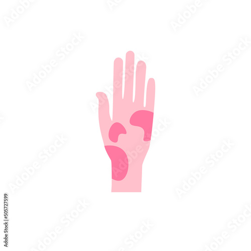 Contact dermatitis flat design long shadow color icon. Skin redness, rash, irritation. Phytophotodermatitis, poisonous plant allergy. Food, insect bite allergic symptom. Vector silhouette illustration