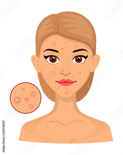 For women, skin types with acne, problem skin, enlarged area for cosmetology. Acne, wrinkles and age spots. Caring for the skin. vector