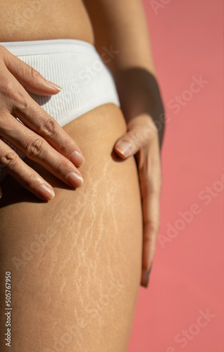 Close up female legs with stretch marks on pink background.