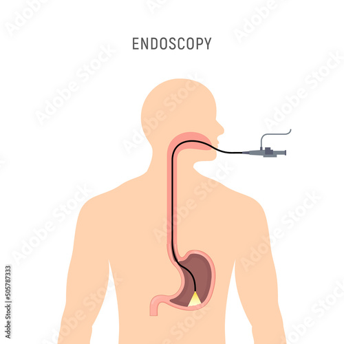 Endoscopy stomach anatomy equipment vector illustration. Esophagus endoscope body exam, gastroscopy human instrument photo