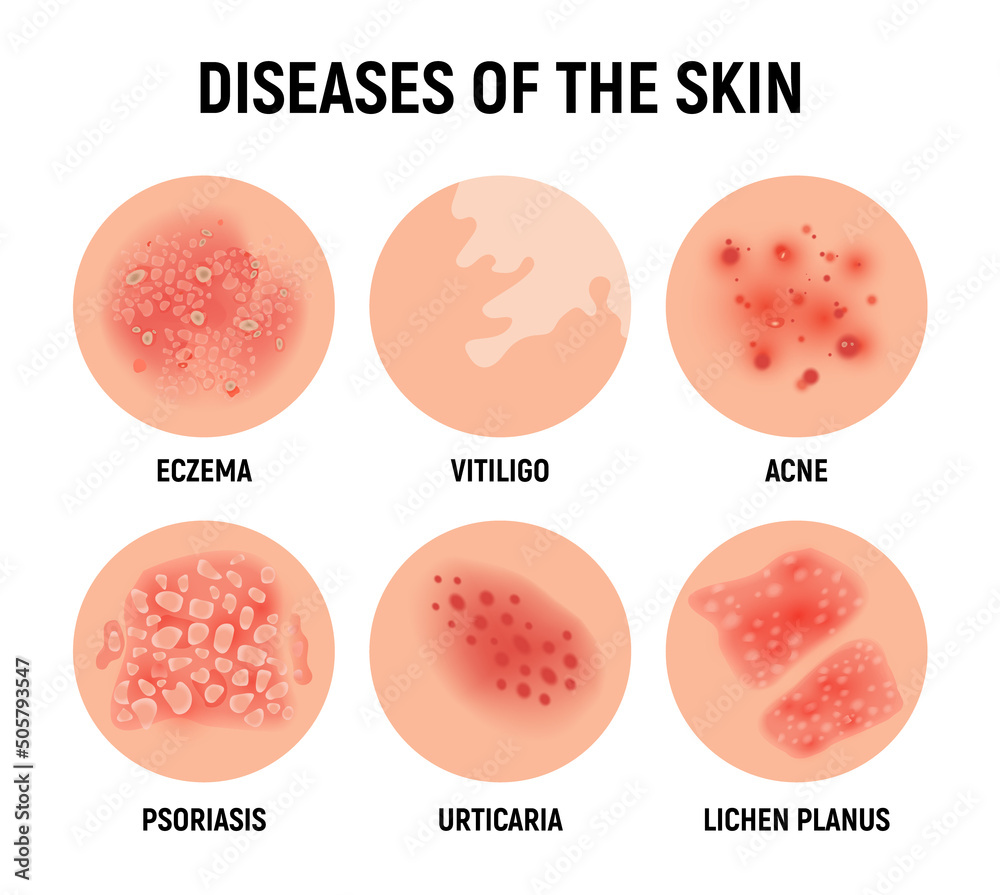 Eczema rash top