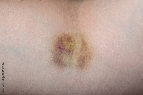 A human hand elbow to painful after taking a blood test from a vein, a bruise on the body the concept of medical violence, hands with bruise close-up texture of skin.